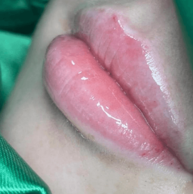 Lip filler 
