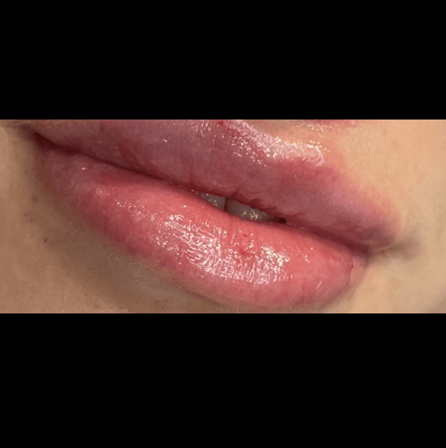 Lip filler 