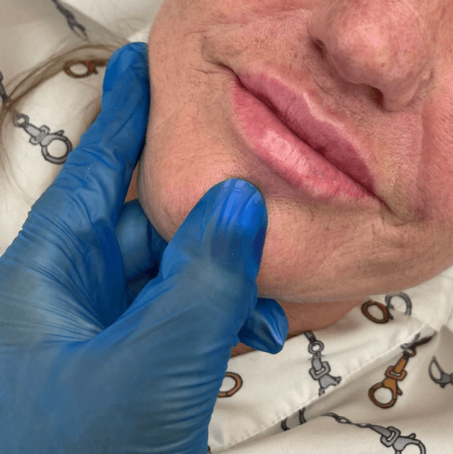 Lip filler 