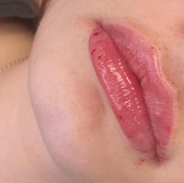 Lip filler 