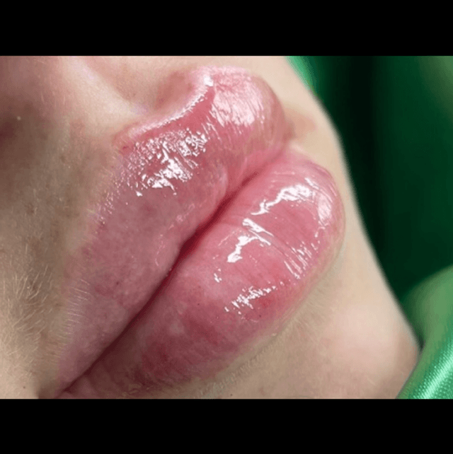 Lip filler 